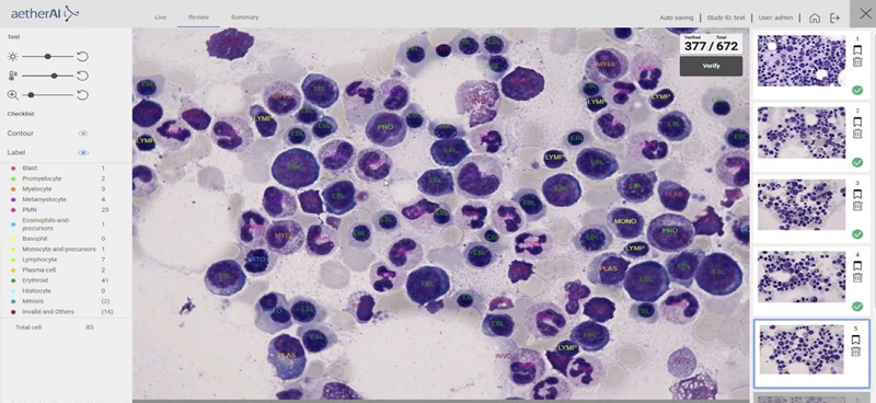 The software's user interface displays the pre-processed image of bone marrow cells, and provides a report on the percentage and number of cell categories. Image: aetherAI