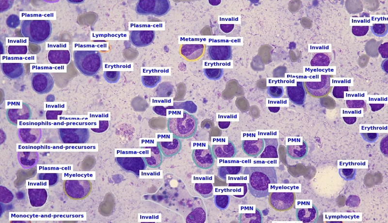 Differentiation and categorization of nucleated bone marrow cells using aetherAI's Microscope x Hema which analyses images made by DFK 33UX183 microscope cameras. Image: aetherAI